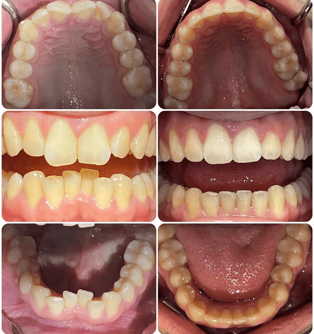 Invisalign before and after grid — top, front, and bottom views showing teeth alignment improvement