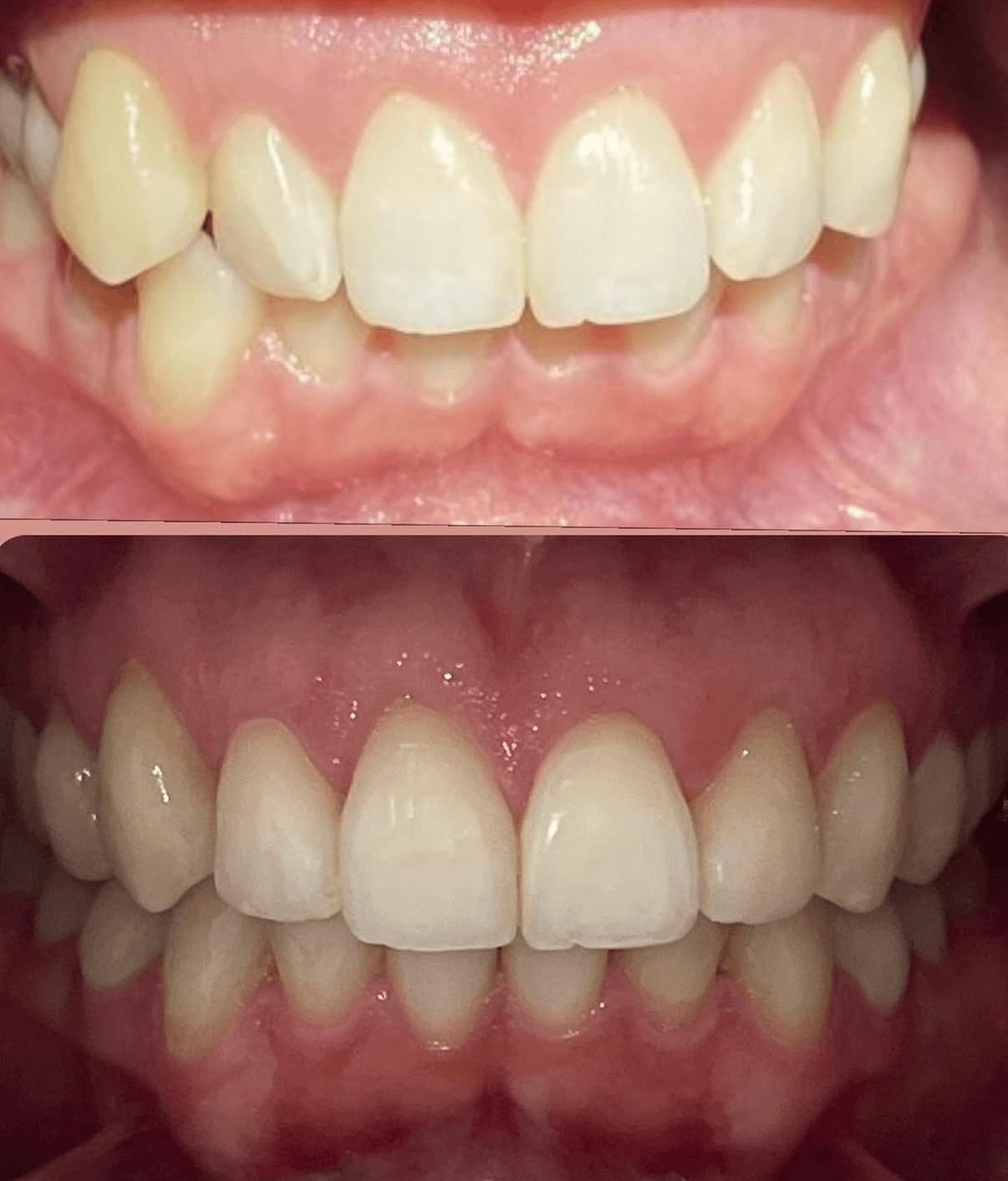 Invisalign before and after — teeth alignment results at Kirkland Premier Dentistry