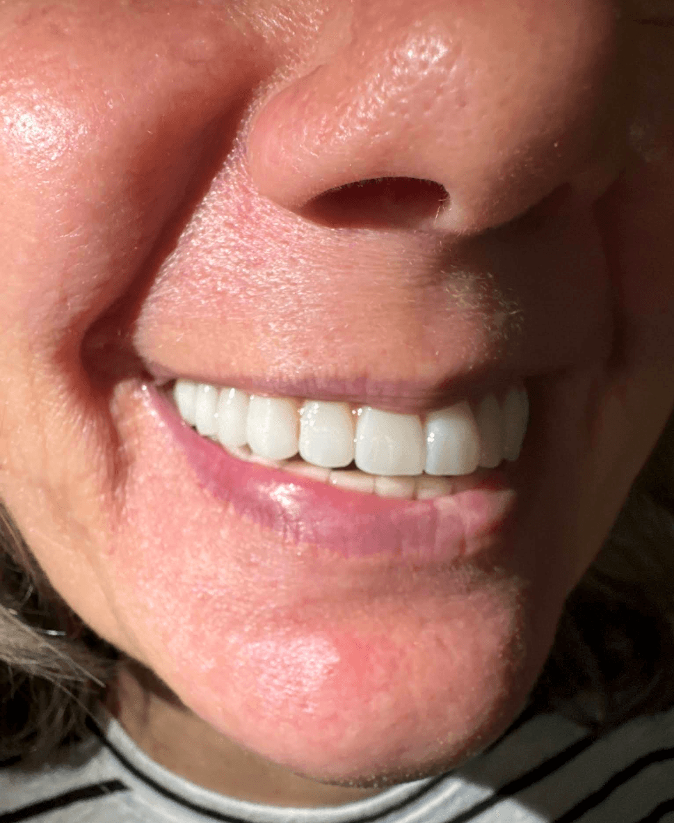 Nadiya Kravchuk — Cosmetic Dentistry results
