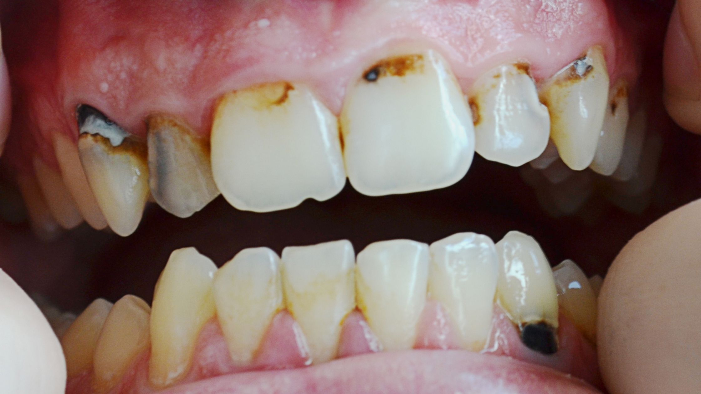 Tartar on Teeth (Dental Calculus): Causes & Removal
